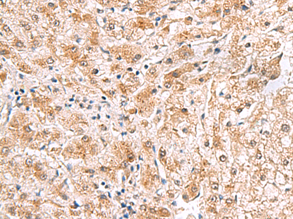 Immunohistochemistry of paraffin-embedded Human liver cancer tissue  using PDCL2 Polyclonal Antibody at dilution of 1:65(×200)