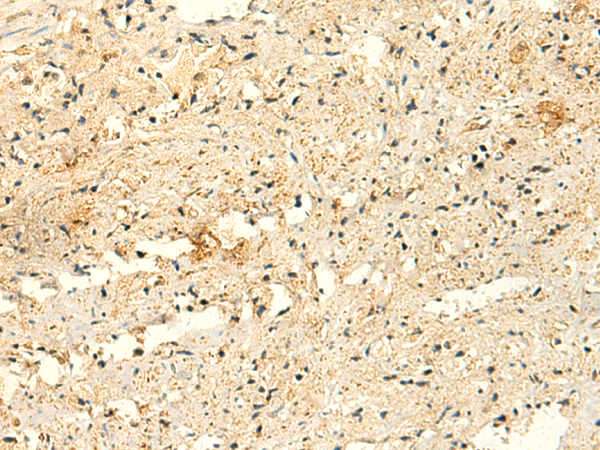 Immunohistochemistry of paraffin-embedded Human prost ate cancer tissue  using GLYATL2 Polyclonal Antibody at dilution of 1:50(×200)