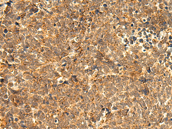 Immunohistochemistry of paraffin-embedded Human lung cancer tissue  using ABHD10 Polyclonal Antibody at dilution of 1:50(×200)