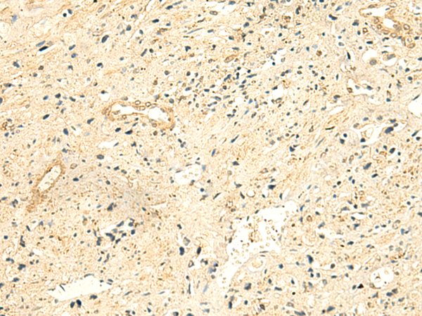 Immunohistochemistry of paraffin-embedded Human prost ate cancer tissue  using NTAN1 Polyclonal Antibody at dilution of 1:50(×200)