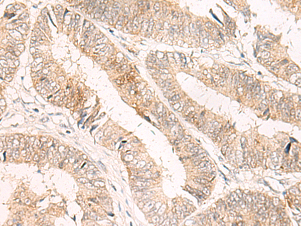 Immunohistochemistry of paraffin-embedded Human colorectal cancer tissue  using TRAPPC1 Polyclonal Antibody at dilution of 1:50(×200)