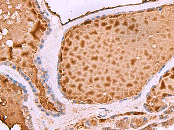 Immunohistochemistry of paraffin-embedded Human thyroid cancer tissue  using ASTE1 Polyclonal Antibody at dilution of 1:50(×200)