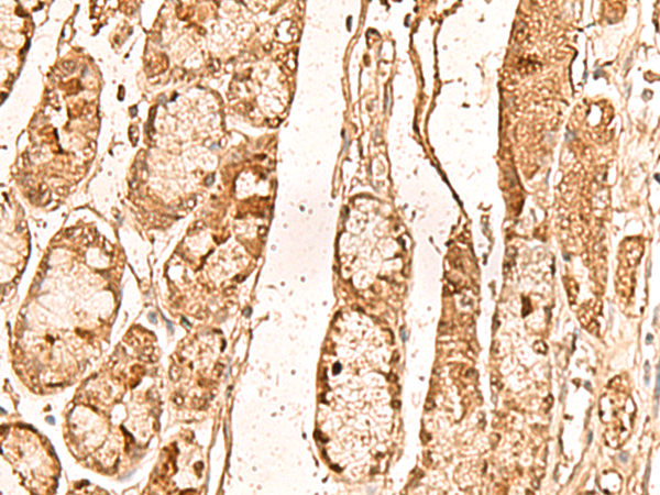 Immunohistochemistry of paraffin-embedded Human liver cancer tissue  using WDR33 Polyclonal Antibody at dilution of 1:65(×200)