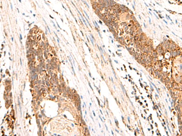 Immunohistochemistry of paraffin-embedded Human esophagus cancer tissue  using CYYR1 Polyclonal Antibody at dilution of 1:85(×200)