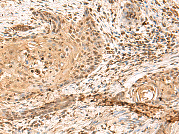 Immunohistochemistry of paraffin-embedded Human esophagus cancer tissue  using PTH1R Polyclonal Antibody at dilution of 1:65(×200)