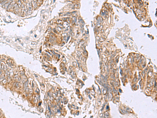 Immunohistochemistry of paraffin-embedded Human colorectal cancer tissue  using RTKN2 Polyclonal Antibody at dilution of 1:75(×200)