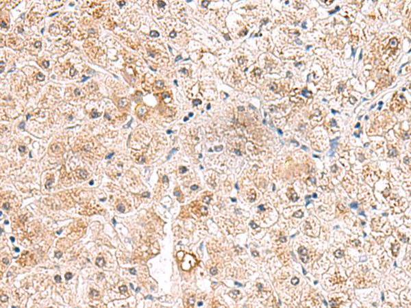 Immunohistochemistry of paraffin-embedded Human liver cancer tissue  using RTKN2 Polyclonal Antibody at dilution of 1:75(×200)