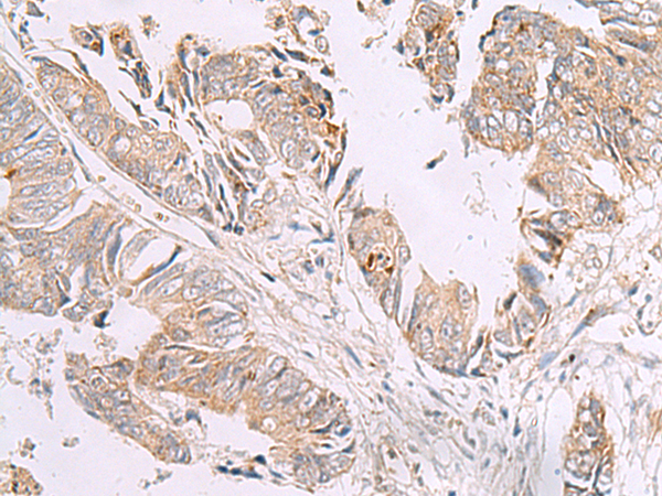 Immunohistochemistry of paraffin-embedded Human colorectal cancer tissue  using GIMAP2 Polyclonal Antibody at dilution of 1:55(×200)