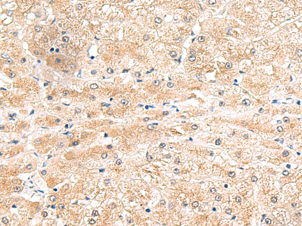 Immunohistochemistry of paraffin-embedded Human liver cancer tissue  using LRG1 Polyclonal Antibody at dilution of 1:50(×200)