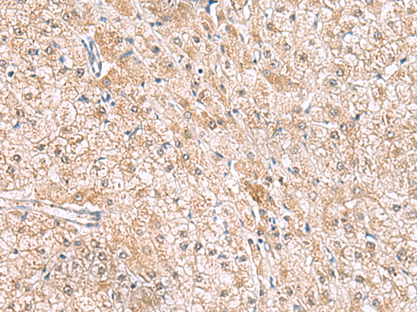 Immunohistochemistry of paraffin-embedded Human liver cancer tissue  using HLA-E Polyclonal Antibody at dilution of 1:50(×200)