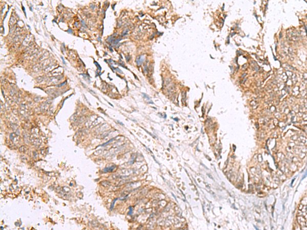 Immunohistochemistry of paraffin-embedded Human colorectal cancer tissue  using HLA-E Polyclonal Antibody at dilution of 1:50(×200)