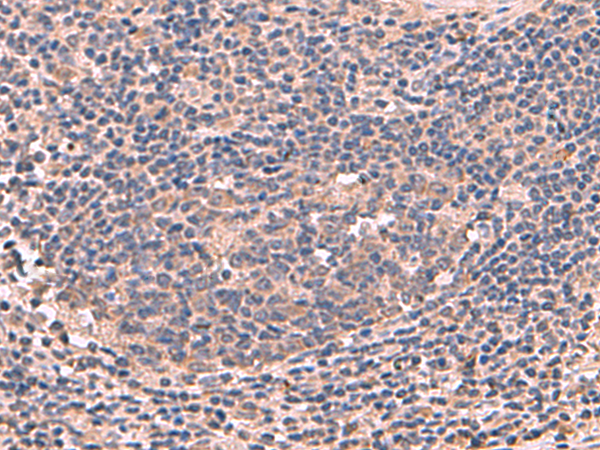 Immunohistochemistry of paraffin-embedded Human cervical cancer tissue  using MAGEC2 Polyclonal Antibody at dilution of 1:60(×200)