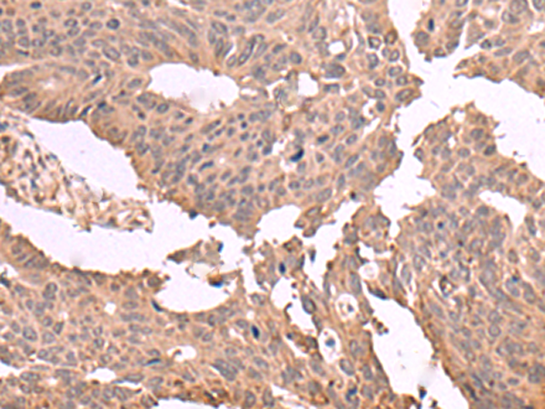 Immunohistochemistry of paraffin-embedded Human colorectal cancer tissue  using MAGEC2 Polyclonal Antibody at dilution of 1:60(×200)