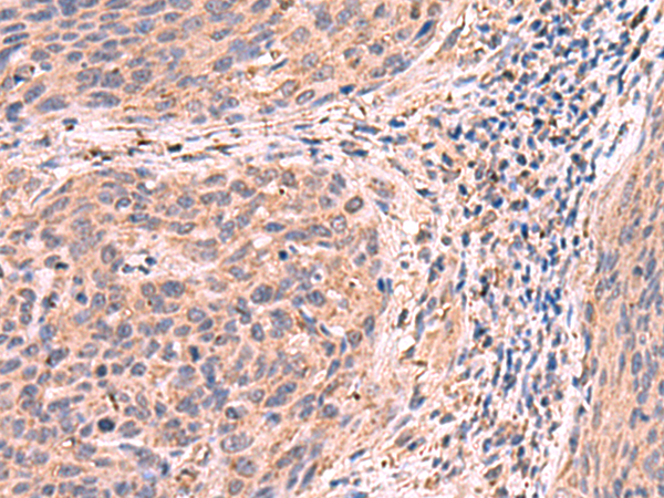 Immunohistochemistry of paraffin-embedded Human cervical cancer tissue  using PER3 Polyclonal Antibody at dilution of 1:55(×200)