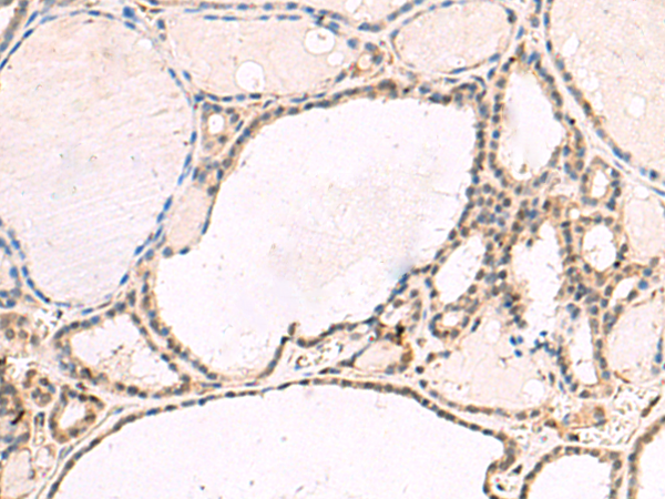 Immunohistochemistry of paraffin-embedded Human thyroid cancer tissue  using RNF13 Polyclonal Antibody at dilution of 1:60(×200)