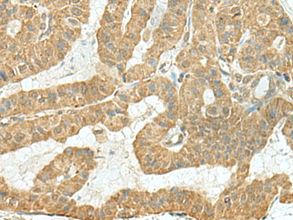 Immunohistochemistry of paraffin-embedded Human thyroid cancer tissue  using TENT5C Polyclonal Antibody at dilution of 1:110(×200)