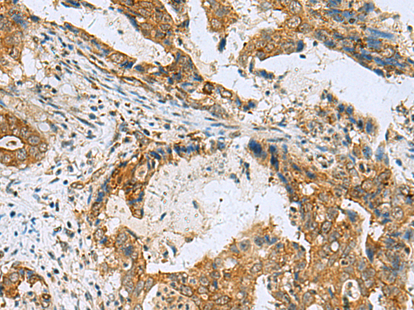 Immunohistochemistry of paraffin-embedded Human cervical cancer tissue  using TUBD1 Polyclonal Antibody at dilution of 1:70(×200)