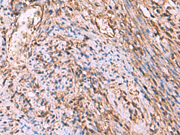 Immunohistochemistry of paraffin-embedded Human cervical cancer tissue  using RHAG Polyclonal Antibody at dilution of 1:130(×200)