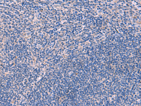 Immunohistochemistry of paraffin-embedded Human tonsil tissue  using SCCPDH Polyclonal Antibody at dilution of 1:85(×200)