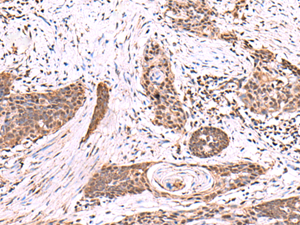 Immunohistochemistry of paraffin-embedded Human esophagus cancer tissue  using SCCPDH Polyclonal Antibody at dilution of 1:85(×200)