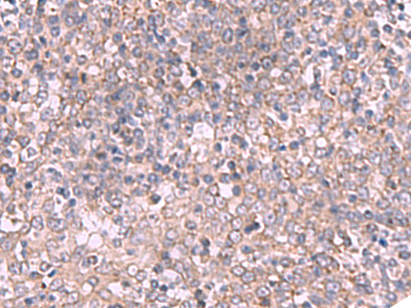 Immunohistochemistry of paraffin-embedded Human tonsil tissue  using ECSIT Polyclonal Antibody at dilution of 1:70(×200)