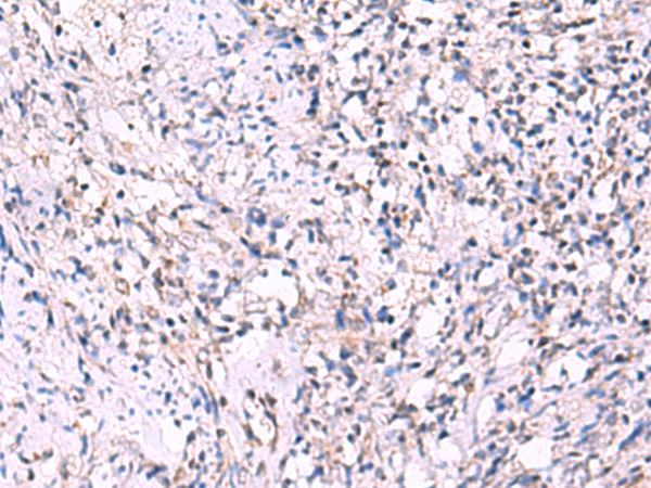Immunohistochemistry of paraffin-embedded Human cervical cancer tissue  using ECSIT Polyclonal Antibody at dilution of 1:70(×200)