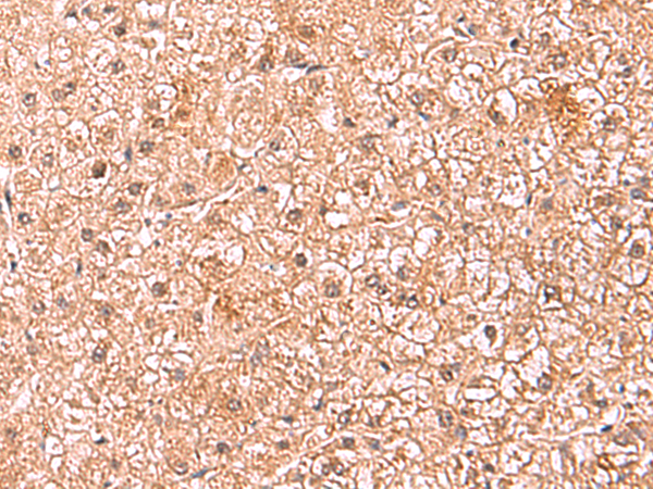 Immunohistochemistry of paraffin-embedded Human liver cancer tissue  using ASTN2 Polyclonal Antibody at dilution of 1:80(×200)