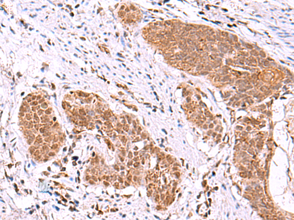 Immunohistochemistry of paraffin-embedded Human esophagus cancer tissue  using ASTN2 Polyclonal Antibody at dilution of 1:80(×200)