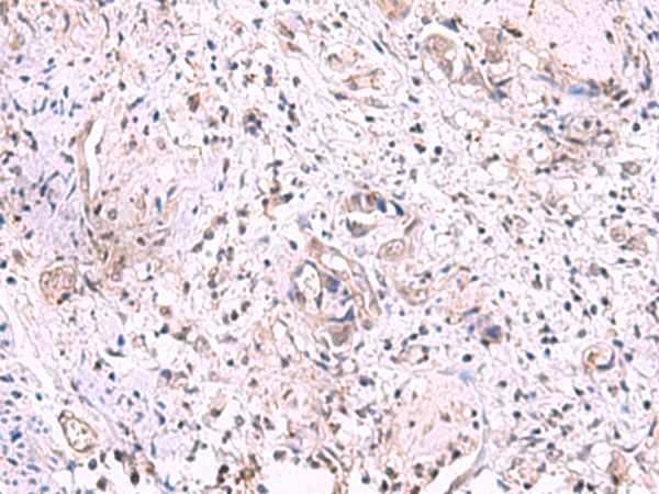 Immunohistochemistry of paraffin-embedded Human cervical cancer tissue  using KIR3DL1 Polyclonal Antibody at dilution of 1:95(×200)