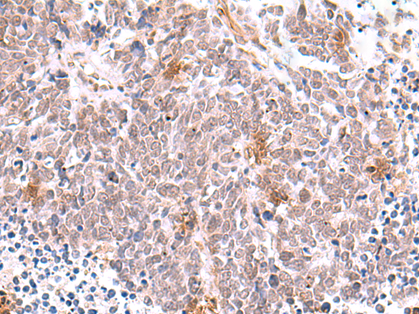 Immunohistochemistry of paraffin-embedded Human lung cancer tissue  using INPP5K Polyclonal Antibody at dilution of 1:90(×200)