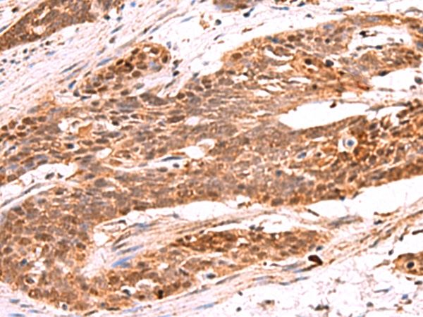 Immunohistochemistry of paraffin-embedded Human esophagus cancer tissue  using RRP8 Polyclonal Antibody at dilution of 1:80(×200)