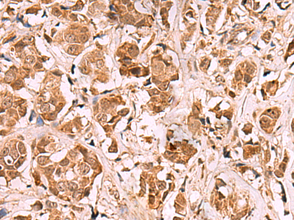 Immunohistochemistry of paraffin-embedded Human breast cancer tissue  using RRP8 Polyclonal Antibody at dilution of 1:80(×200)