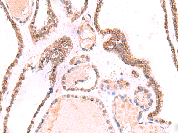Immunohistochemistry of paraffin-embedded Human thyroid cancer tissue  using TOR1AIP1 Polyclonal Antibody at dilution of 1:70(×200)