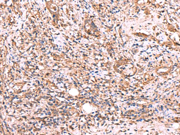 Immunohistochemistry of paraffin-embedded Human cervical cancer tissue  using TTC38 Polyclonal Antibody at dilution of 1:50(×200)