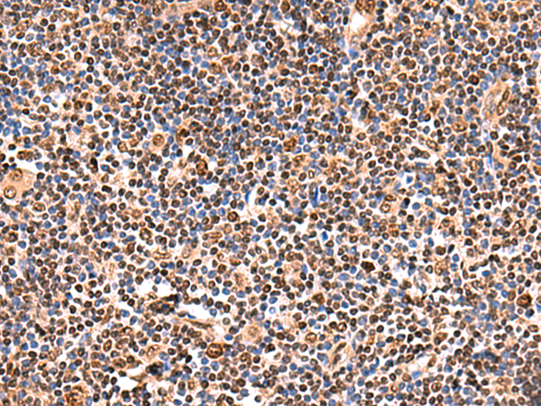 Immunohistochemistry of paraffin-embedded Human tonsil tissue  using GPKOW Polyclonal Antibody at dilution of 1:140(×200)