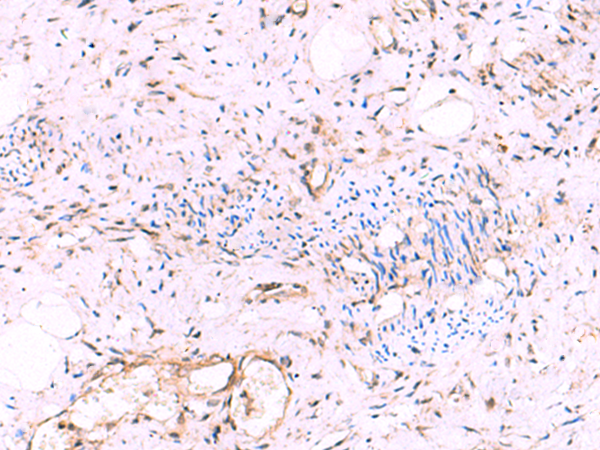 Immunohistochemistry of paraffin-embedded Human cervical cancer tissue  using KATNAL1 Polyclonal Antibody at dilution of 1:95(×200)