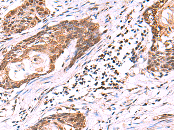 Immunohistochemistry of paraffin-embedded Human esophagus cancer tissue  using KATNAL1 Polyclonal Antibody at dilution of 1:95(×200)