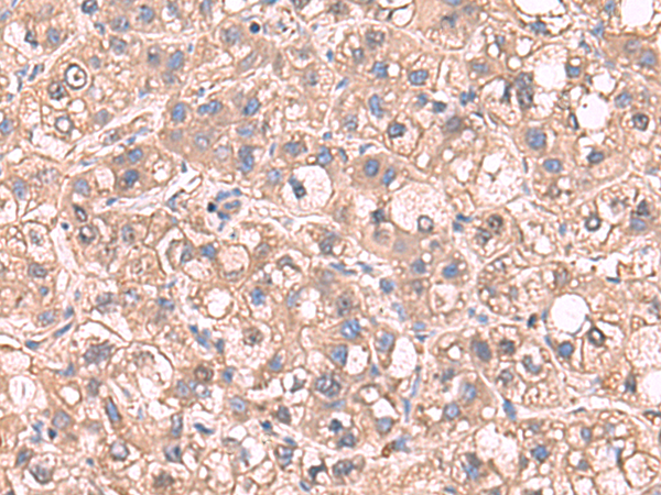 Immunohistochemistry of paraffin-embedded Human liver cancer tissue  using SARS Polyclonal Antibody at dilution of 1:65(×200)