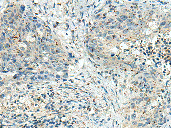 Immunohistochemistry of paraffin-embedded Human cervical cancer tissue  using PAK1IP1 Polyclonal Antibody at dilution of 1:120(×200)