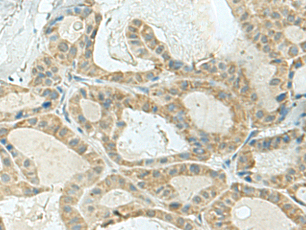 Immunohistochemistry of paraffin-embedded Human thyroid cancer tissue  using KLC2 Polyclonal Antibody at dilution of 1:120(×200)