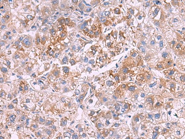 Immunohistochemistry of paraffin-embedded Human liver cancer tissue  using GSTCD Polyclonal Antibody at dilution of 1:70(×200)