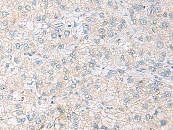 Immunohistochemistry of paraffin-embedded Human liver cancer tissue  using FARP2 Polyclonal Antibody at dilution of 1:70(×200)