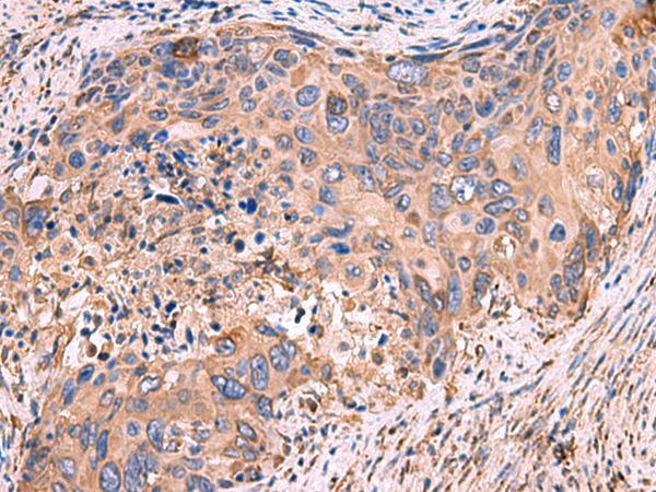 Immunohistochemistry of paraffin-embedded Human cervical cancer tissue  using GUSB Polyclonal Antibody at dilution of 1:50(×200)