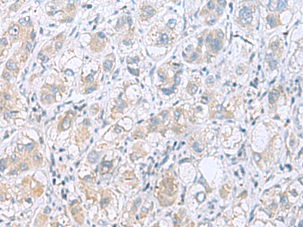 Immunohistochemistry of paraffin-embedded Human liver cancer tissue  using GPCPD1 Polyclonal Antibody at dilution of 1:55(×200)