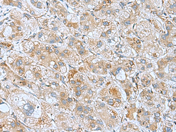 Immunohistochemistry of paraffin-embedded Human liver cancer tissue  using DHX58 Polyclonal Antibody at dilution of 1:60(×200)