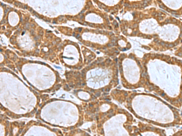 Immunohistochemistry of paraffin-embedded Human thyroid cancer tissue  using KIF2A Polyclonal Antibody at dilution of 1:55(×200)