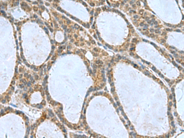 Immunohistochemistry of paraffin-embedded Human thyroid cancer tissue  using CNTN4 Polyclonal Antibody at dilution of 1:65(×200)