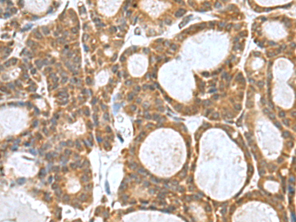 Immunohistochemistry of paraffin-embedded Human thyroid cancer tissue  using KANSL1L Polyclonal Antibody at dilution of 1:80(×200)