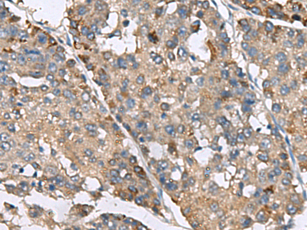 Immunohistochemistry of paraffin-embedded Human liver cancer tissue  using IP6K2 Polyclonal Antibody at dilution of 1:220(×200)