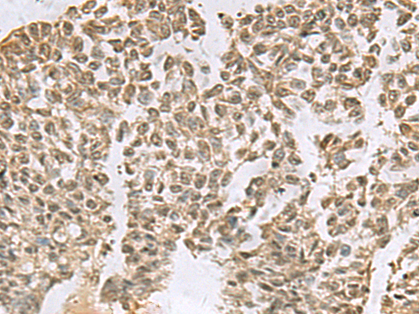 Immunohistochemistry of paraffin-embedded Human ovarian cancer tissue  using ELOC Polyclonal Antibody at dilution of 1:55(×200)